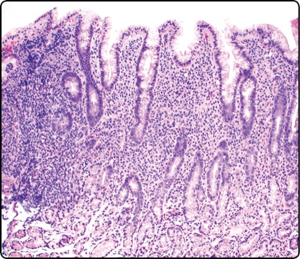 ‘Normal’ Stomach on Endoscopy May Be Anything But