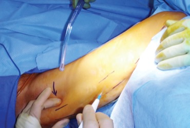 Tummy Pooch San Diego - Restore SD Plastic Surgery