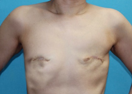 My Breasts Were Removed Due To Cancer. Living Flat-Chested Didn't